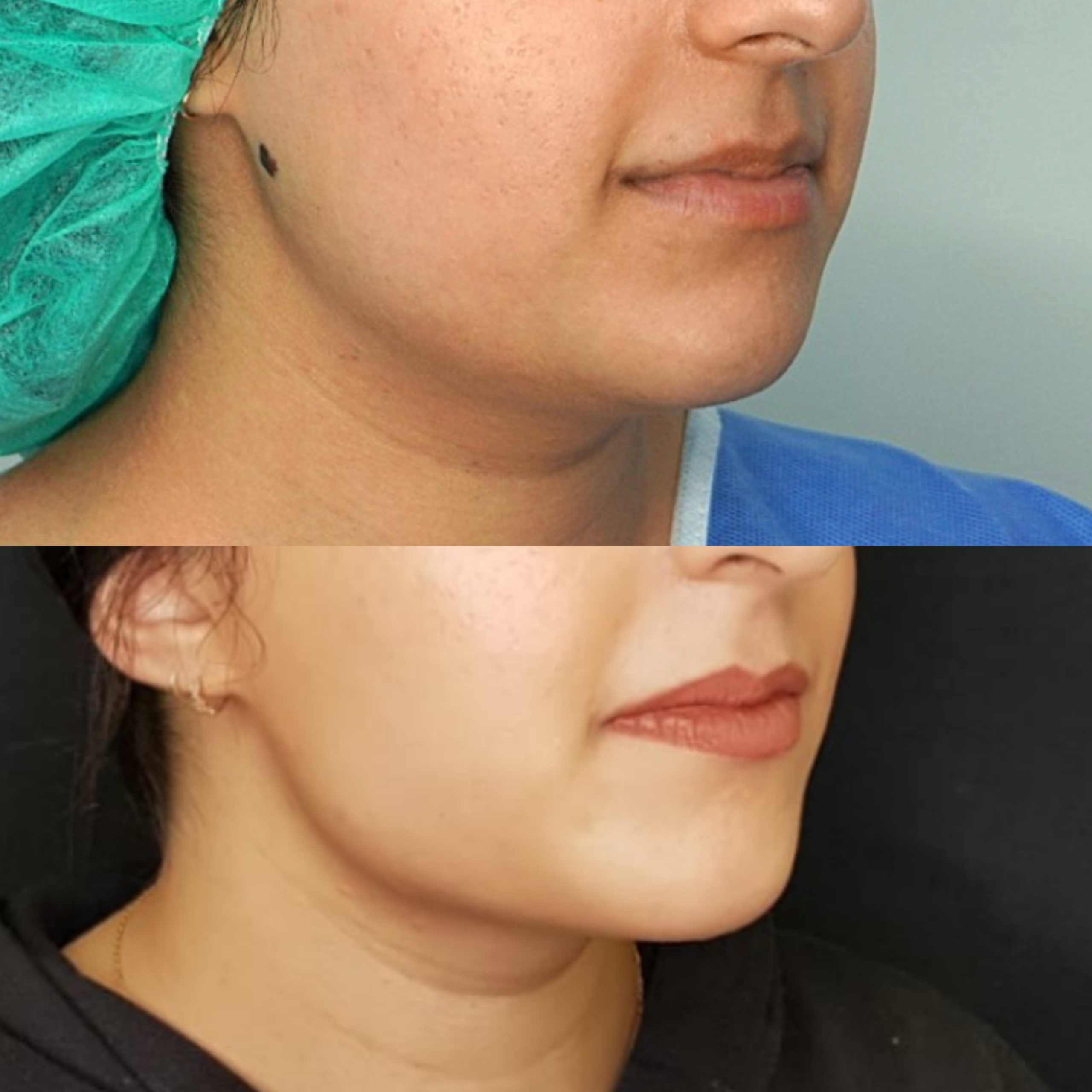 FaceTite & Liposuction jawline