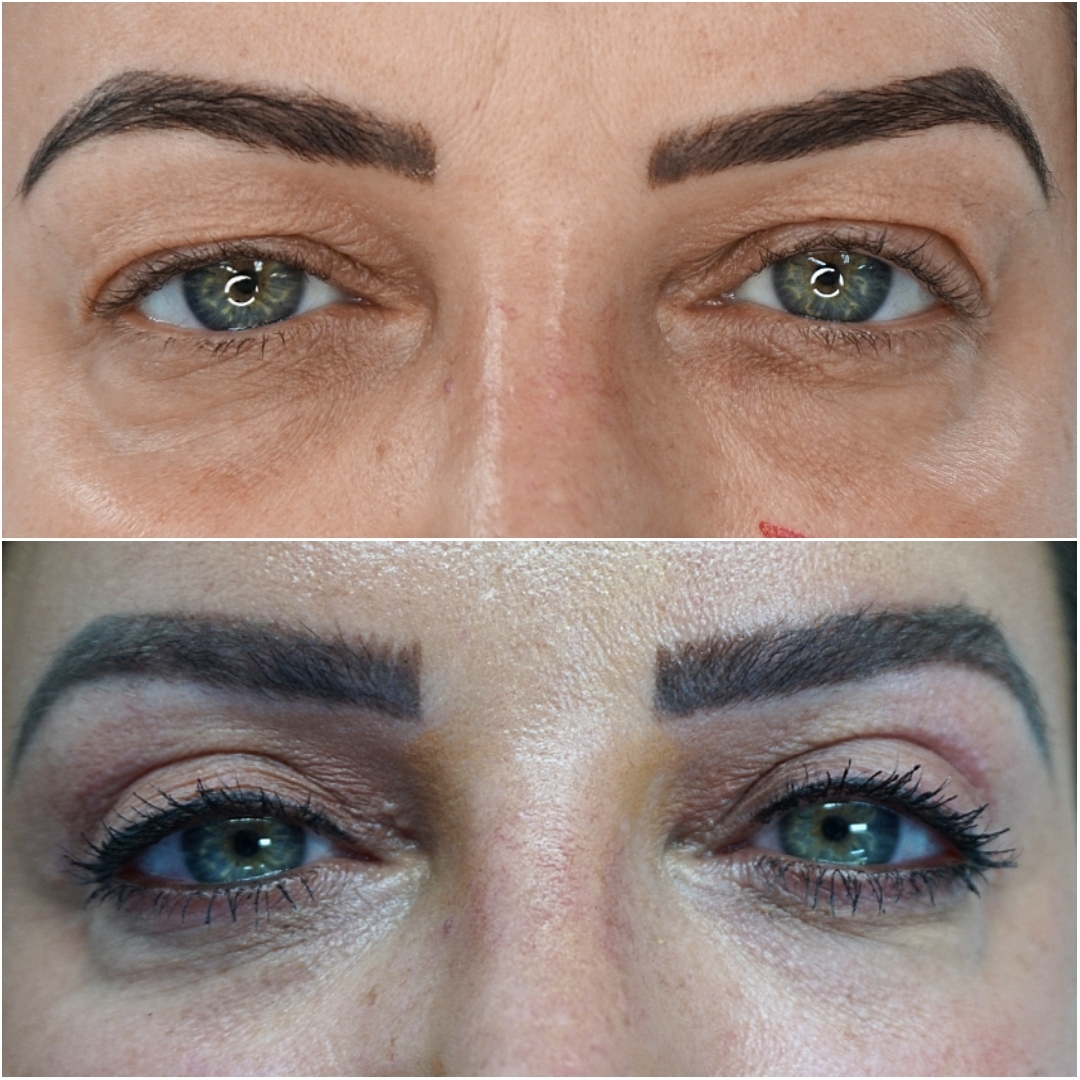 Eyelid lift