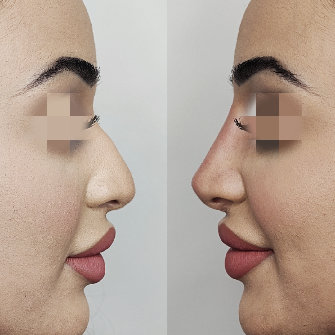 3 Point Rhino Nose Correction Aesthetics Plastic Surgery