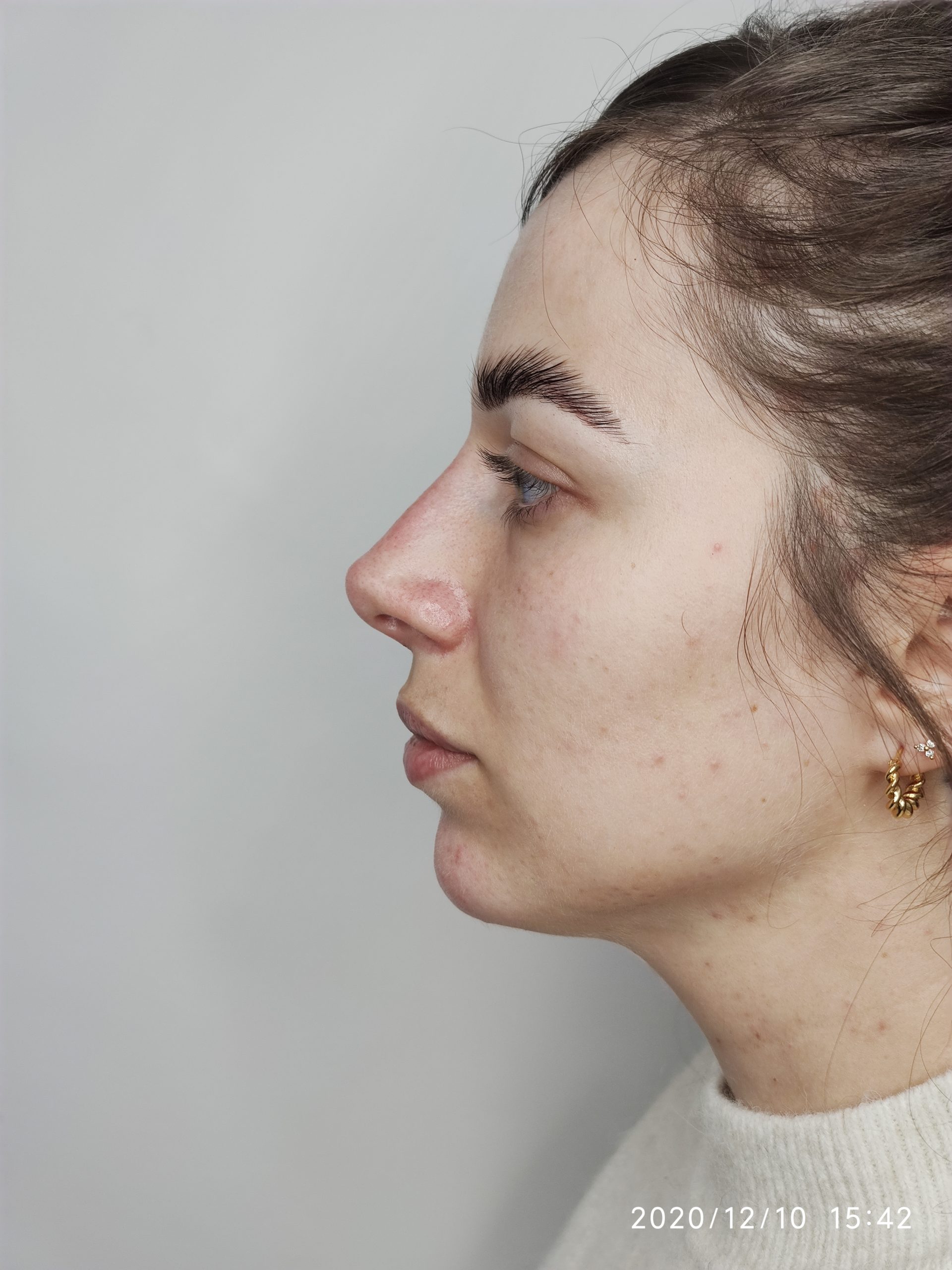 Side profile 3 point rhino & chin Side profile 3 point rhino & chin
