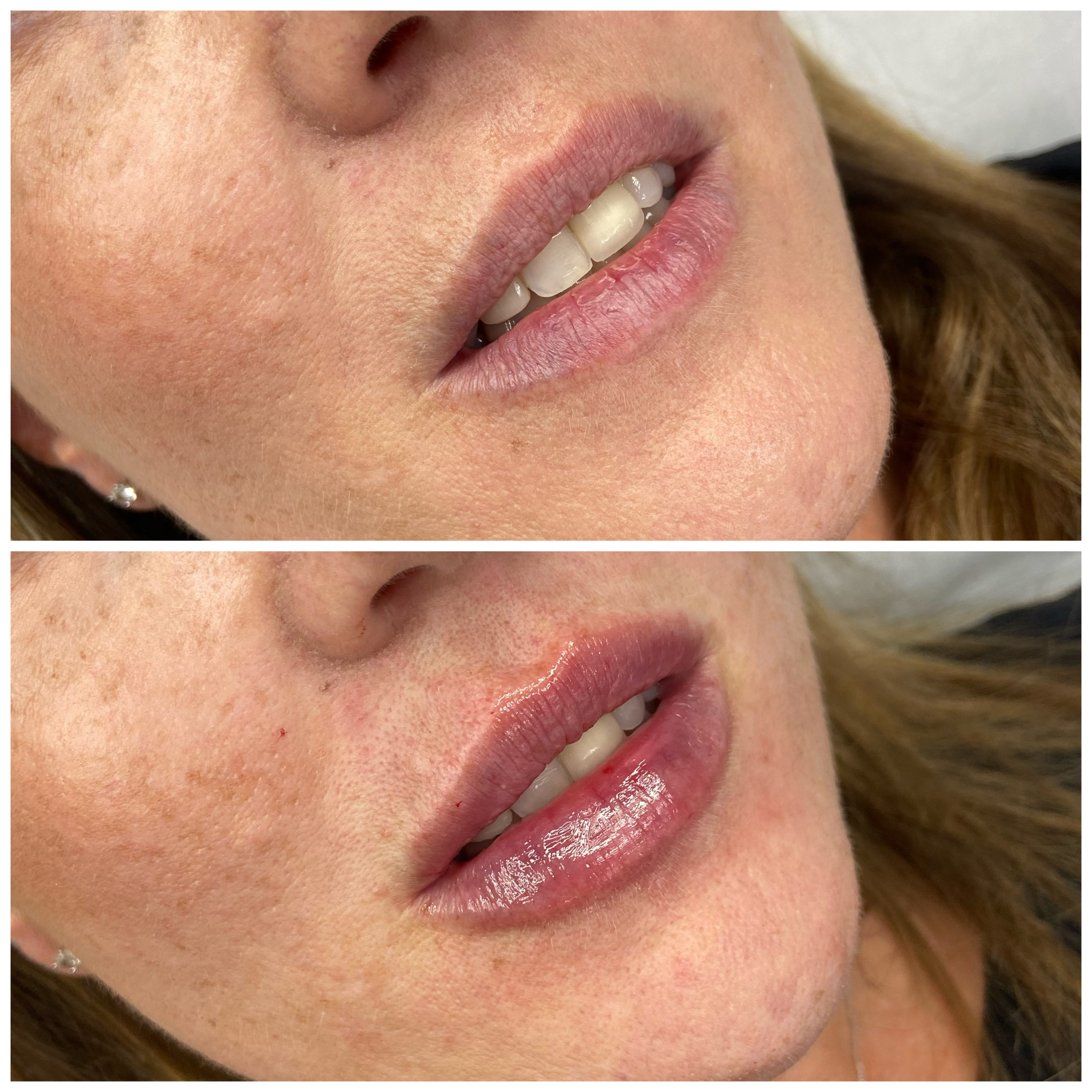 before and after Lip enhancement