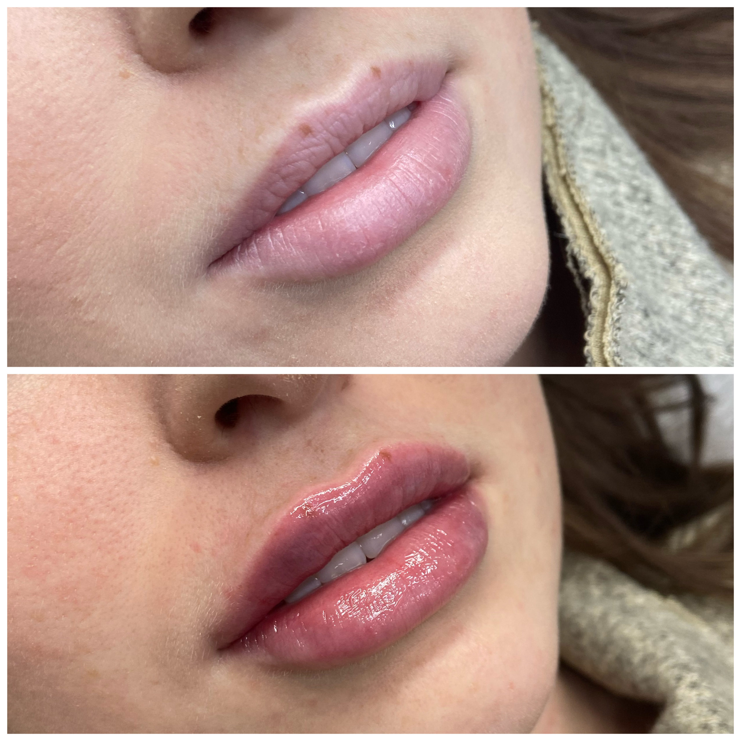 before and after Lip enhancement